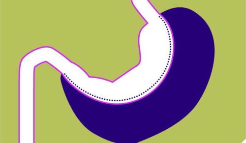 Adipositas-Chirurgie: Schlauchmagen (Grafik: Aktion Meditech/Expertengruppe Metabolische Chirurgie)