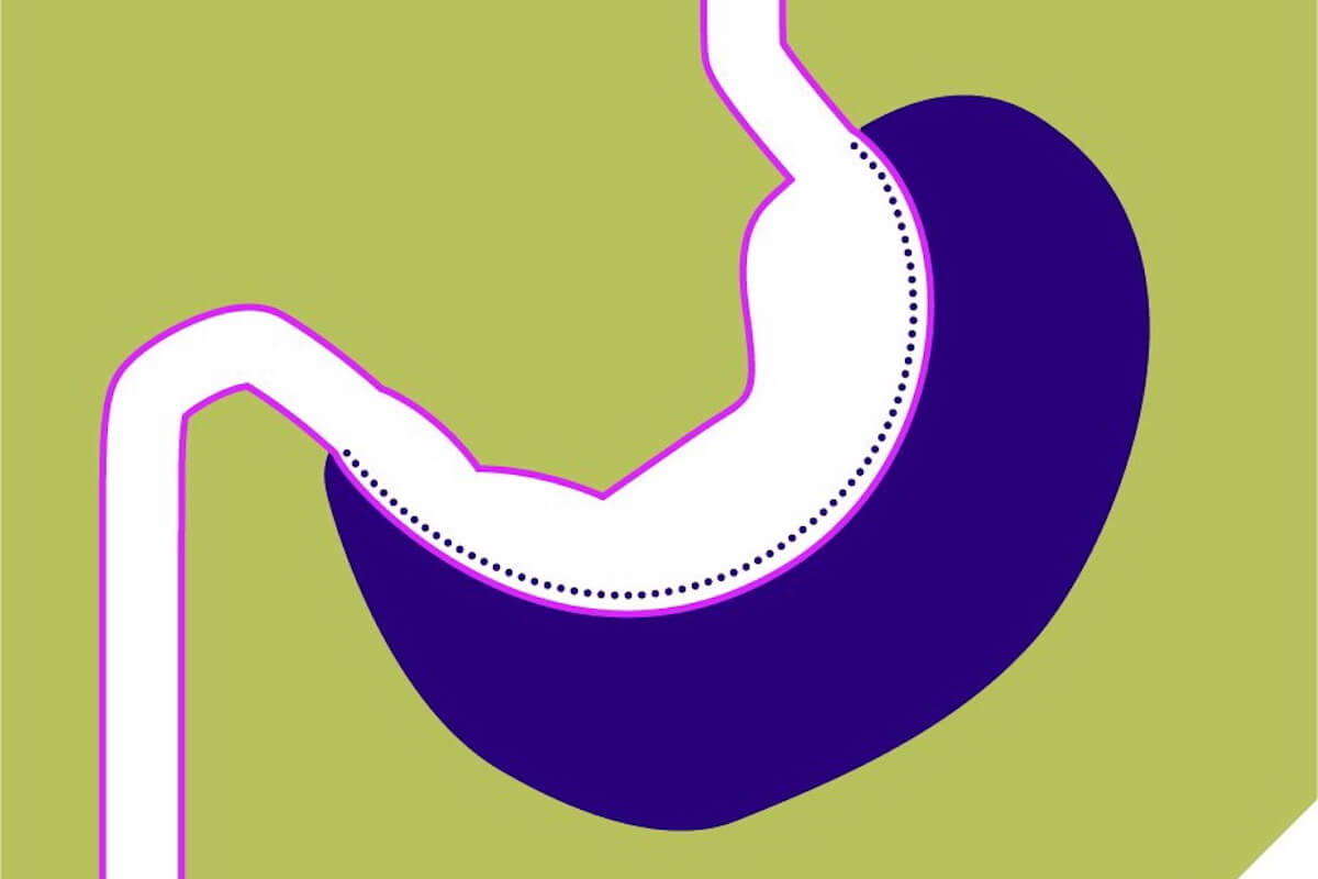 Adipositas-Chirurgie: Schlauchmagen (Grafik: Aktion Meditech/Expertengruppe Metabolische Chirurgie)